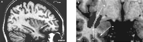 Structure of collateral sulcus | Semantic Scholar