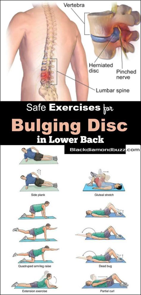 Herniated Disc Exercises for Fast Results- Lower Back Pain Relief