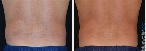 CoolSculpting® for Men