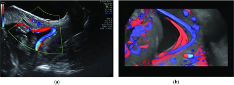 Vasa praevia as (a) 2D color Doppler ultrasound image and (b) 3D Static ...