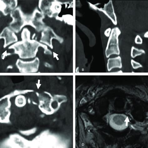 MRI of alar and transverse ligaments. High-resolution proton-weighted ...