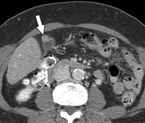 CT Differentiation of Adenomyomatosis and Gallbladder Cancer | AJR