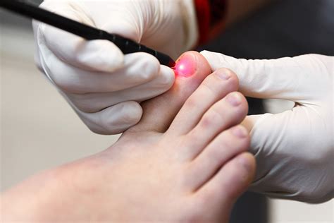 Introducing the Lunula Cold Laser for fungal nail treatment – My FootDr