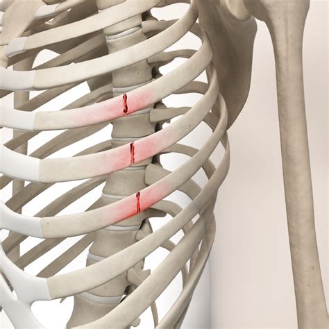 Reporting Rib Fracture Treatment in 2015 - AAPC Knowledge Center