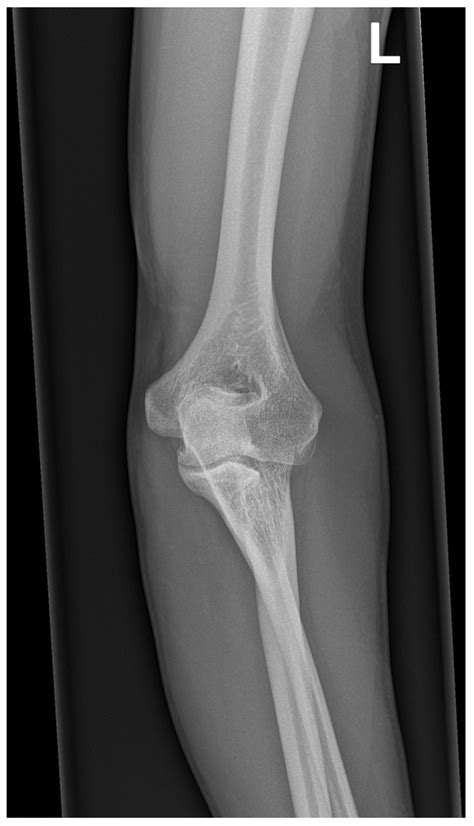 Medicina | Free Full-Text | Congenital Proximal Radioulnar Synostosis ...