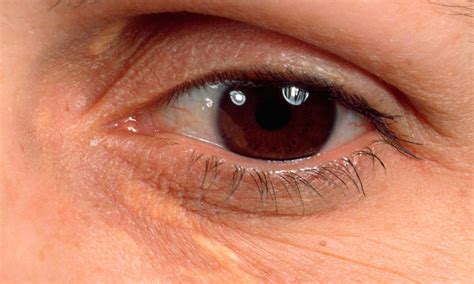 Yellow eyelid marks (xanthelasma) 'early warning sign of heart disease' | Daily Mail Online