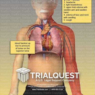 Superior Vena Cava Syndrome - TrialExhibits Inc.