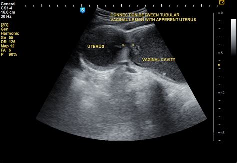 Imperforate Hymen Repair