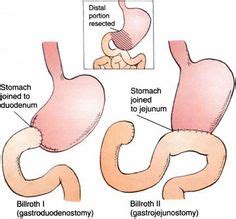 Types of PARTIAL GASTRECTOMIES. Billroth 1 --> Gastroduodenostomy Billroth II ...