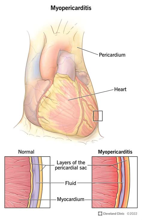 Myopericarditis: Symptoms, Causes & Treatment