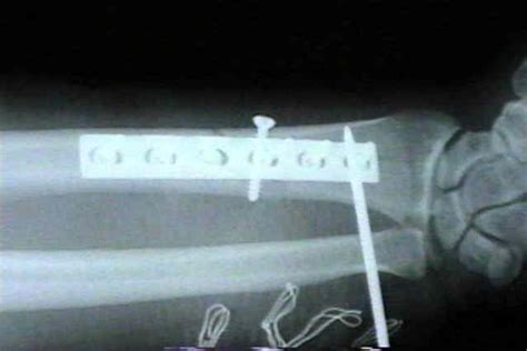 Galeazzi Fracture Classification