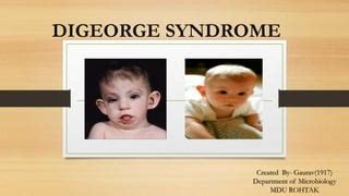 DiGeorge Syndrome || Deletion Syndrome || Immunodeficiency , 54% OFF