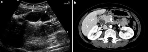 Intestinal Tuberculosis | Radiology Key