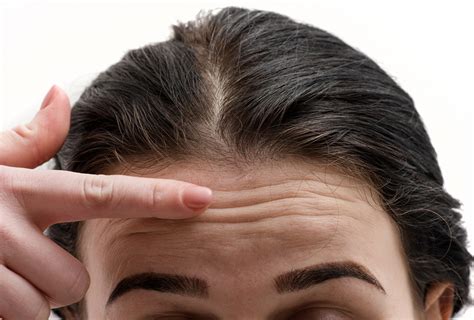 Possible Reasons for Forehead Wrinkles & Treatment Options