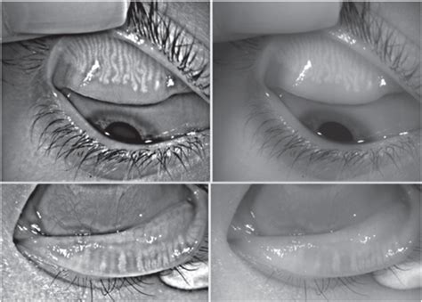 A Better Meibomian Gland Work-up: See What You’ve Been Missing