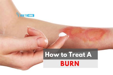 Best Ways To Treat Burns With Honey & Essential Oils - Health - Nigeria