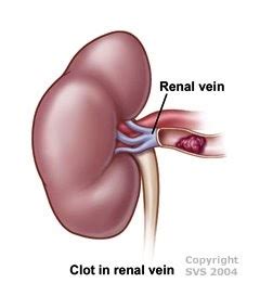 Renal Fellow Network: Renal Vein Thrombosis