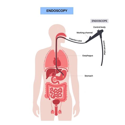 Premium Vector | Gastroscopy procedure Gastroenterologist uses a gastroscope Stomach and ...