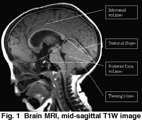 Figure 1 from Estimation of Posterior Fossa Volume in Pediatric Patients with Chiari ...