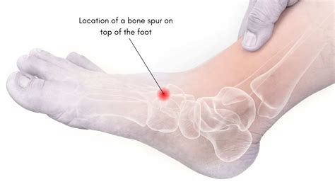 Bone Spur on top of foot: explained by a foot specialist