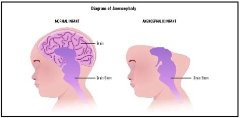 Causes Of Anencephaly
