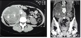 Pyonephrosis