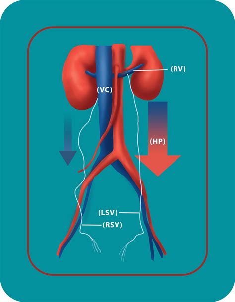 Causes & Treament of Varicocele | Georgiadis Urology