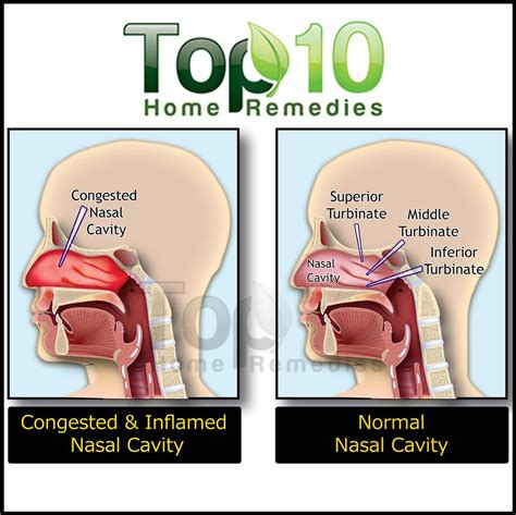 Home Remedies for Nasal Congestion | Top 10 Home Remedies