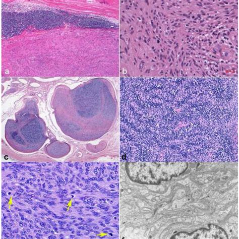 Rare schwannoma patterns and variants | Download Scientific Diagram