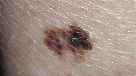 Discolored Skin Patches: Pictures, Causes, and Treatments