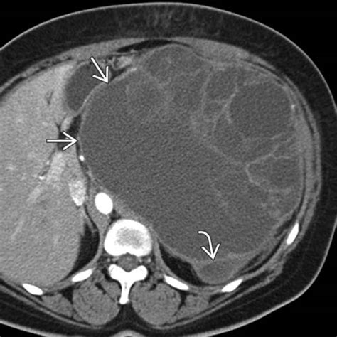 Mucinous Cystic Pancreatic Tumor | Radiology Key