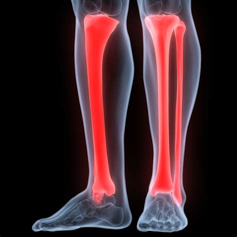 Tibial Fracture after Accident – The Vrana Law Firm Personal Injury Attorneys