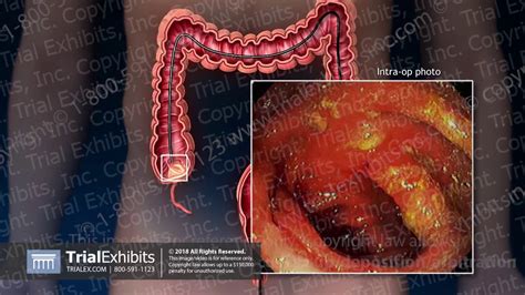 Colonoscopy with Polyp Removal - YouTube