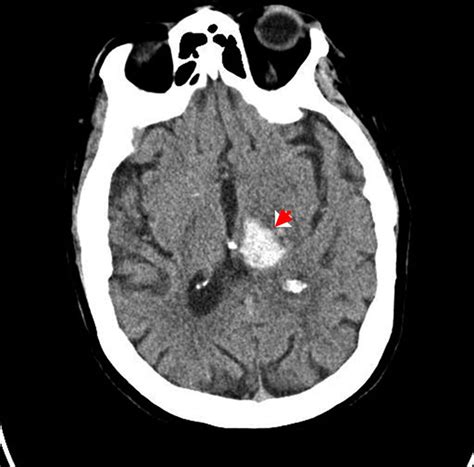 Intracranial Hemorrhage - Cause, Symptoms, Diagnosis, Treatment