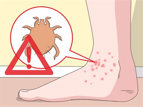 3 Ways to Stop Itchy Feet - wikiHow