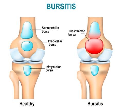 What is Bursitis? - WristSupports.co.uk