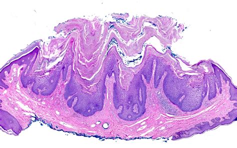 Pathology Outlines - Epidermolytic acanthoma