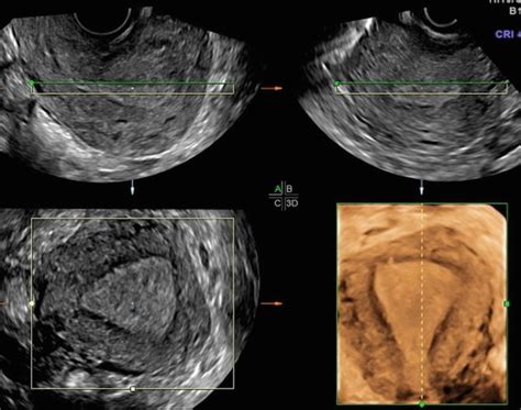 The Normal Uterus | Radiology Key