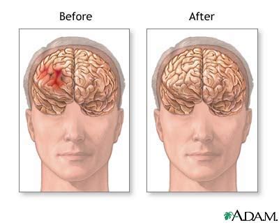 Before and after hematoma repair: MedlinePlus Medical Encyclopedia Image