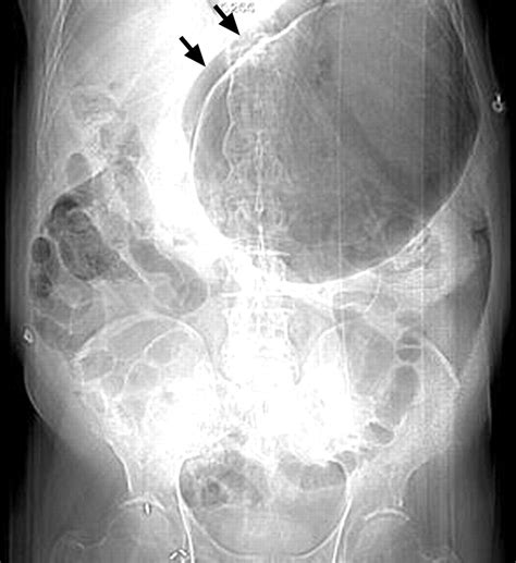 Volvulus of the Gastrointestinal Tract: Appearances at Multimodality Imaging | RadioGraphics