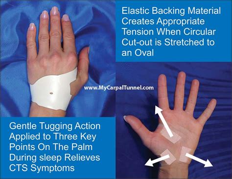 Tennis and Carpal Tunnel | Prevention & Natural Treatment