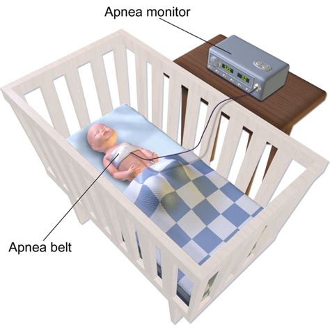 Apnea of Prematurity — Treatment and Guidelines | Medical Library