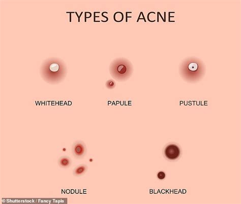 The six types of pimple and how to deal with each one | Daily Mail Online