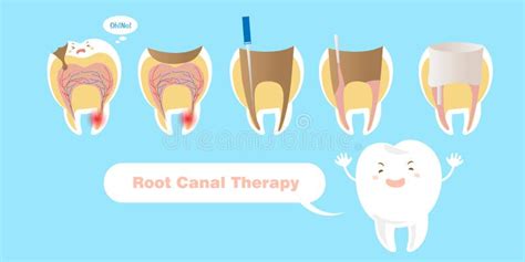 Cartoon Tooth Root Canal Treatment Stock Illustrations – 311 Cartoon Tooth Root Canal Treatment ...