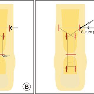 (A) Flexor hallucis longus (FHL) tendon transfer technique. FHL ...