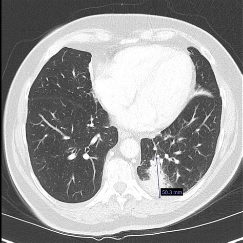 Cureus | Non-Small Cell Lung Cancer With Synchronous Peritoneal Adenocarcinoma: A Rare ...