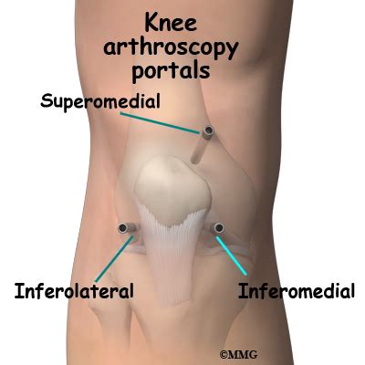 Knee Arthroscopy | eOrthopod.com