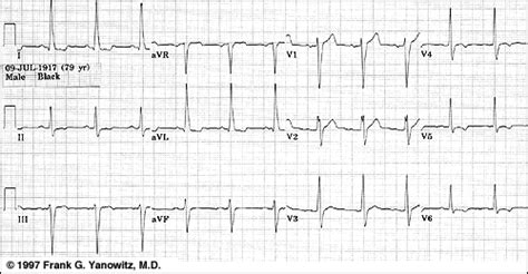 ECG Learning Center - An introduction to clinical electrocardiography