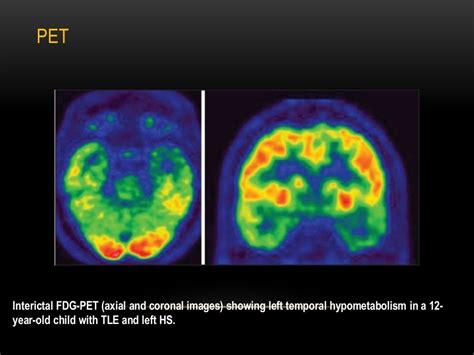 Mesial temporal lobe epilepsy