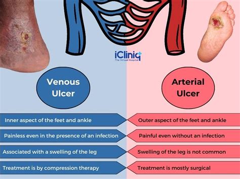 Venous Stasis Ulcer Treatment Pictures Causes Symptoms